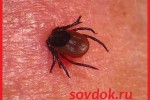 Клещевой энцефалит — симптомы и лечение